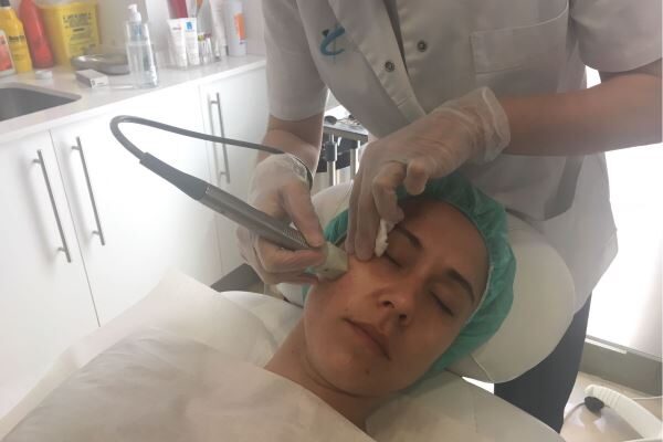Fractora, el nou dispositiu d’Idermic per al tractament de la pell
