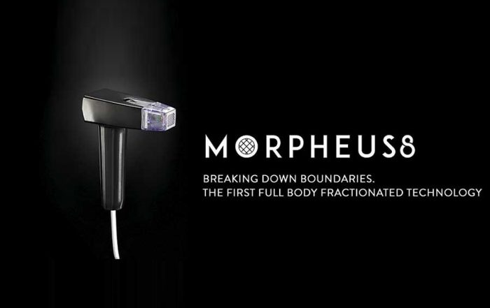 Tratamiento de la hiperhidrosis con Morpheus8 en Idermic de Terrassa