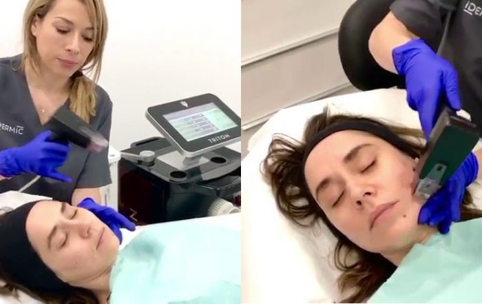 Tratamiento de las cicatrices del acné con Morpheus8 en Idermic de Terrassa