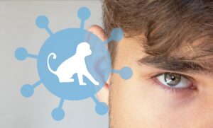 Viruela del mono: Qué es, síntomas, transmisión y prevención.