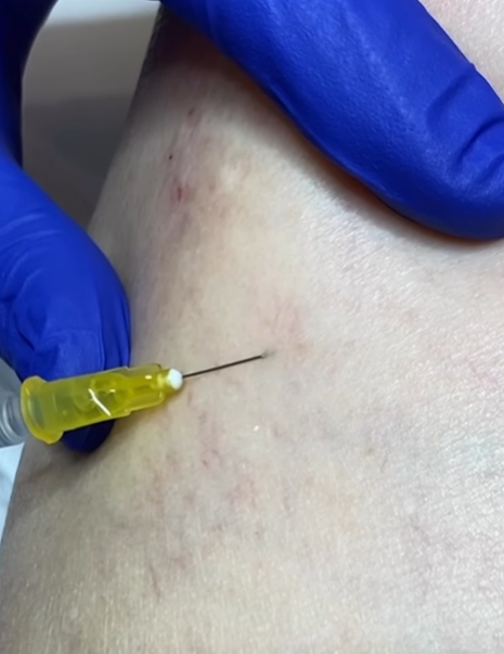 Esclerosis de varices