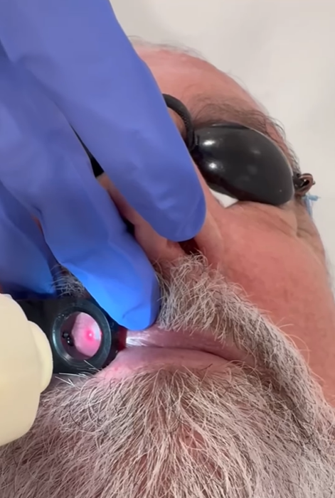 Los lagos venosos son dilataciones venosas que suelen aparecer en los labios