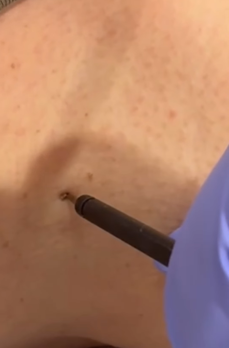 Acrocordones o fibromas blandos