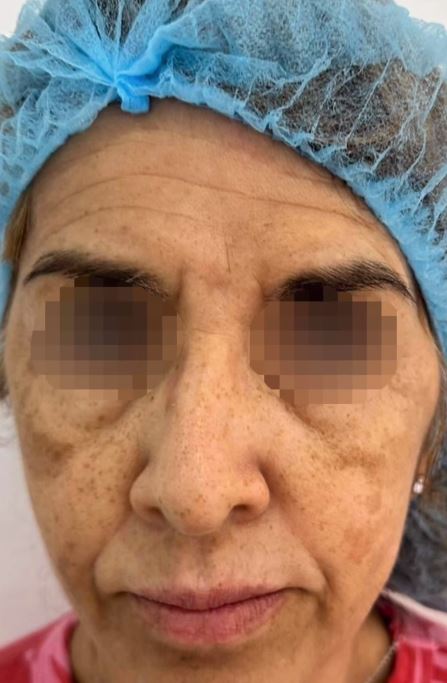 Tratamiento del Melasma
