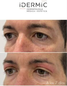 Blefaroplastia con láser CO2. Resultados a los 7 días