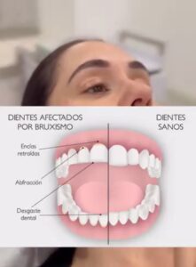 Todo lo que necesitamos saber del bruxismo