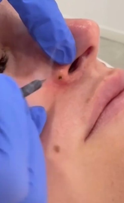 Eliminació de la pàpula fibrosa nasal amb làser de plasma Dermaplax. Foto 1