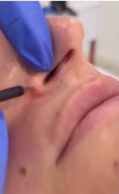 Eliminació de la pàpula fibrosa nasal amb làser de plasma Dermaplax. Foto 2