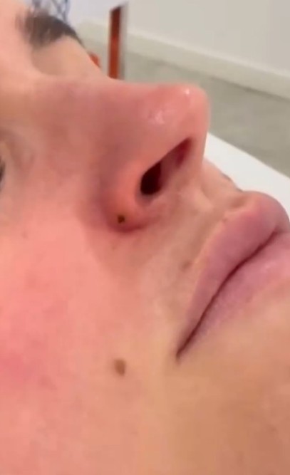 Eliminació de la pàpula fibrosa nasal amb làser de plasma Dermaplax. Foto 3