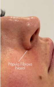 Pápula fibrosa nasal Eliminación de la pápula fibrosa nasal con láser de plasma Dermaplax.