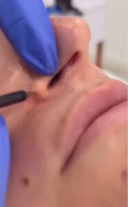 Pápula fibrosa nasal Eliminación de la pápula fibrosa nasal con láser de plasma Dermaplax.
