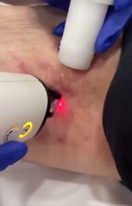 Utilización del Láser Frax 1550 para el tratamiento de estrías.