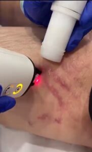 Utilización del Láser Frax 1550 para el tratamiento de estrías.