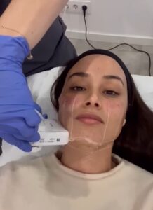 Tratamiento facial HIFU Liftera