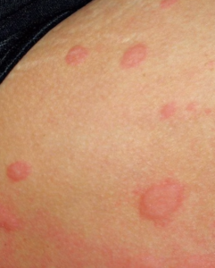 Dermatología pediátrica. Mastocitosis Mastocitosis: Qué es, síntomas, causas y tratamientos
