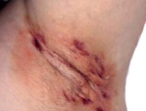 Hidradenitis supurativa en ingles y axilas.
