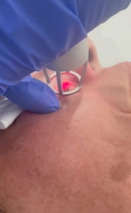 Nevus dérmico Eliminación del Nevus dérmico con láser CO2.