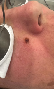 Nevus dérmico Vista del Neus dérmico antes de iniciar el tratamiento.