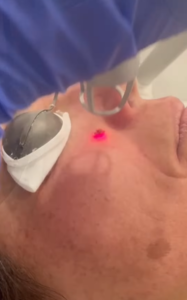 Nevus dérmico Proceso de eliminación del Nevus dérmico con láser CO2.
