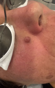 Nevus dérmico Nevus dérmico: Eliminación con láser CO2