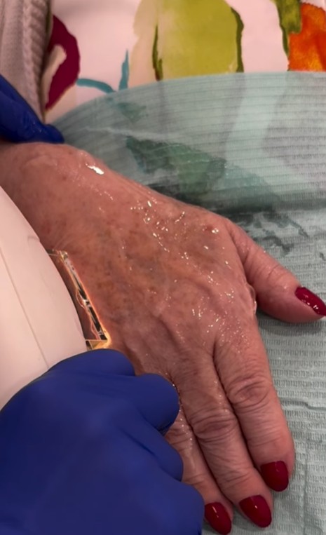 Rejuvenecimiento de manos Tratamiento con IPL.