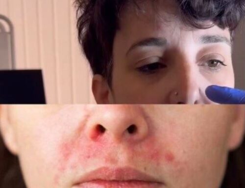 Dermatitis perioral: causes, símptomes i tractament