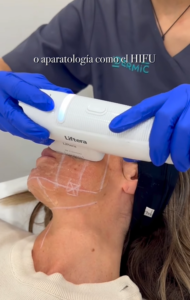 Tratamiento de la flacidez con HIFU