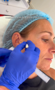 Tratamiento y prevención de la flacidez con ácido hialurónico