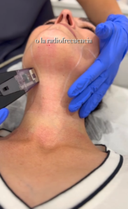 Tratamiento de la flacidez con microagujas.