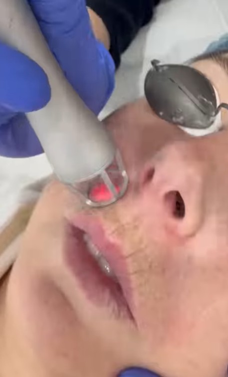 Tratamiento de las arrugas profundas del labio superior.