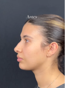 Foto antes de la Rinoplastia Ultrasónica