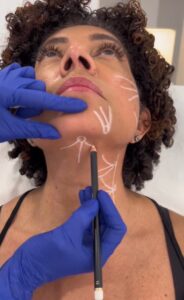 Inductores de colágeno Tratamiento del cuello y el escote con inductores de colágeno.