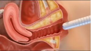 Rejuvenecimiento vaginal con Láser Core