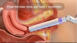 Rejuvenecimiento vaginal con Láser Core