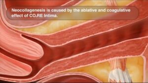 Rejuvenecimiento vaginal con Láser Core