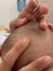 Costra láctea en bebés
