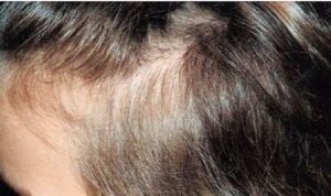 Dermatología pediátrica: el síndrome del anágeno suelto. Foto 1
