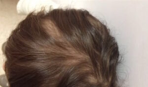 Dermatología pediátrica: el síndrome del anágeno suelto. Foto 2