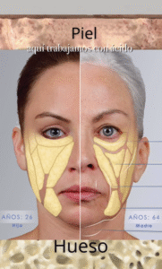 El ácido hialurónico es un tratamiento que se utiliza para compensar la pérdida de volumen y cambios en en la estructura facial a nivel óseo.