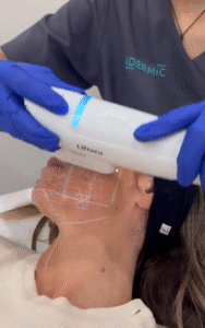 A nivel muscular, cuando los músculos se relajan y se destensan, HIFU y neuroestimulación como mejores soluciones para la flacidez facial.