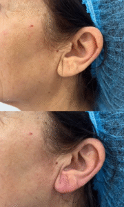 Antes/después del tratamiento con ácido hialurónico del lóbulo de la oreja. Foto 2