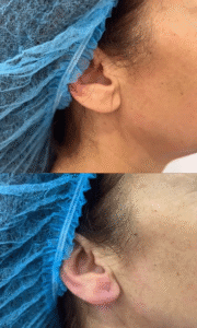 Antes/después del tratamiento con ácido hialurónico del lóbulo de la oreja. Foto 1