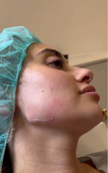 Marcación mandibular con ácido hialurónico