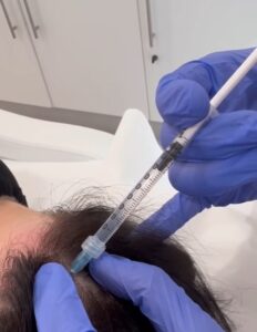 Efluvio telógeno Efluvio telógeno: causas, síntomas y tratamiento de una caída de cabello temporal