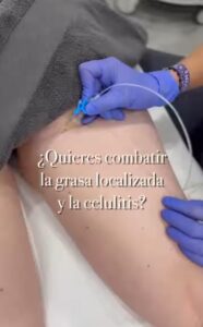 Tratamientos para reducir la grasa localizada y mejorar el aspecto de la piel
