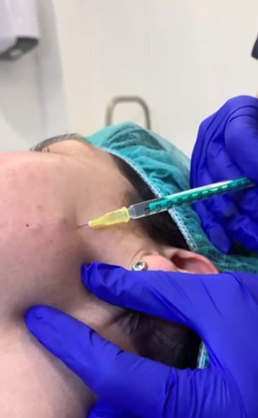Mesoterapia facial: qué es, cómo funciona y sus beneficios reales