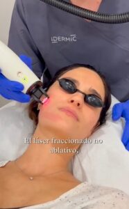 Láser fraccionado no ablativo. Tratamiento para poros dilatados