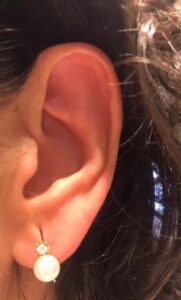 Lobuloplastia: la cirugía estética que repara y rejuvenece los lóbulos de la oreja