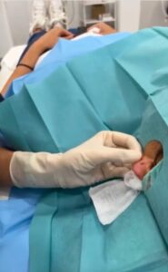 Preparación para una intervención de Lobuloplastia