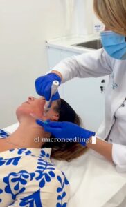 Microneeding. Tratamiento para poros dilatados